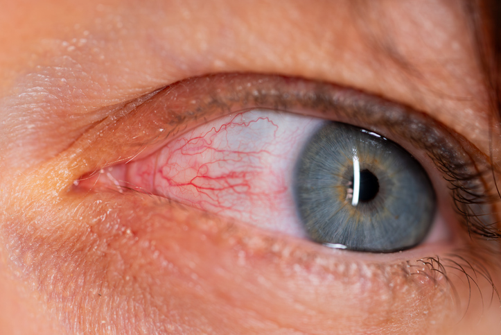 Bloodshot red eye revealing subconjunctival hemorrhage and conjunctival inflammation, signaling potential ocular infection or irritation